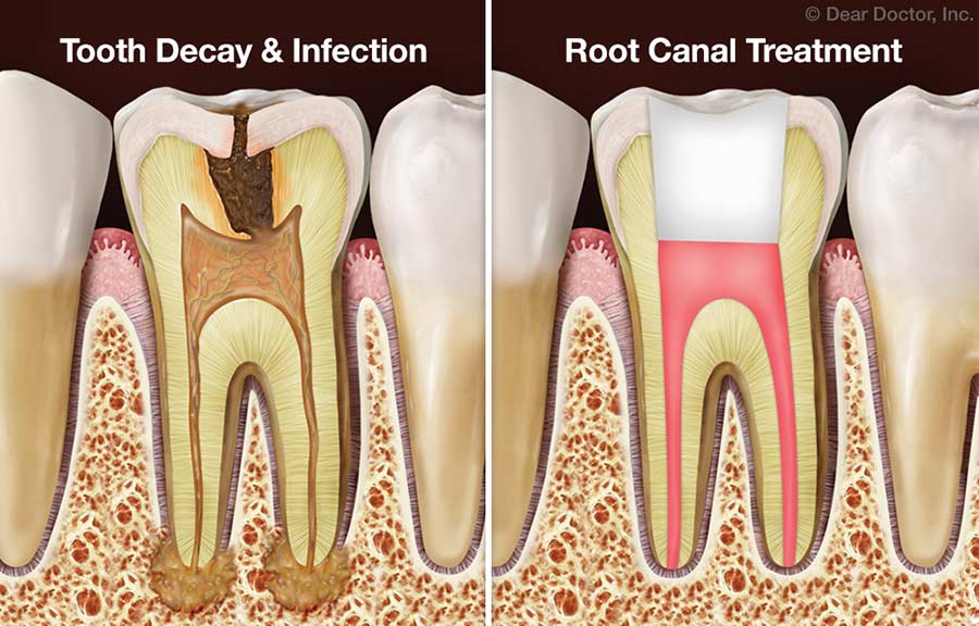 Dental Implants